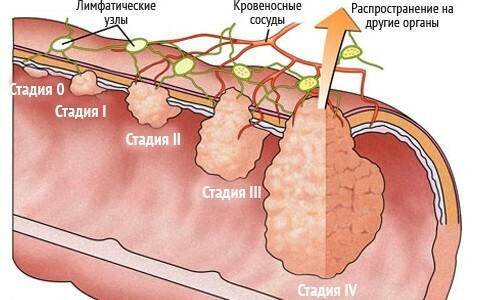 Korak adenokartsenomy crijevo-debelog crijeva( 1)