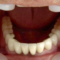 Types of material used for permanent dental prosthetics