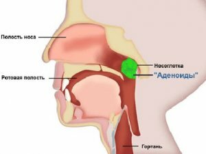 Zdravljenje adenoidov brez kirurškega posega