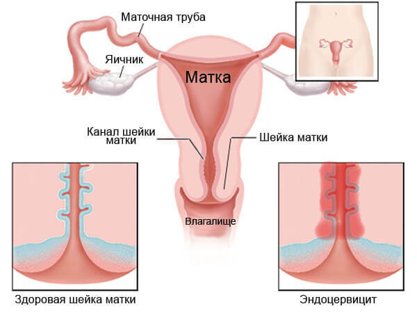 Urogenitalnog mješovite infekcije: što uzrokuje Mycoplasma bolest genitalium