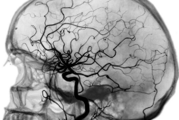 Angiography of cerebral vessels