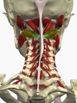 Syndroom van de vertebrale slagader