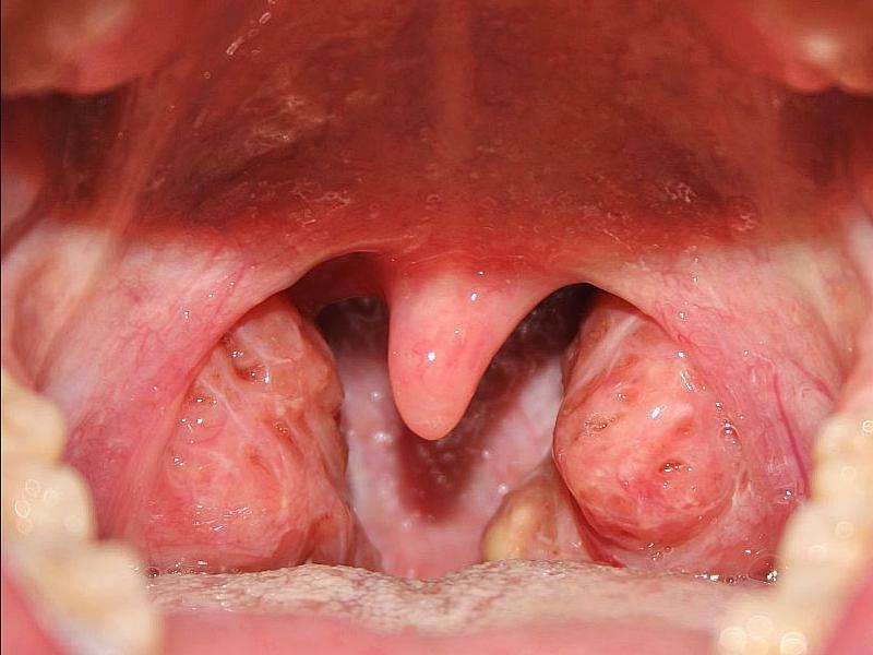I fori nelle tonsille palatine( tonsille) - che cosa si tratta
