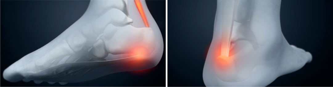 Nahrávání na patní ostruhy: různými technikami nohy kinezioteypirovaniya