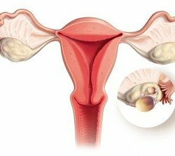 Treatment of ovarian cysts with folk remedies