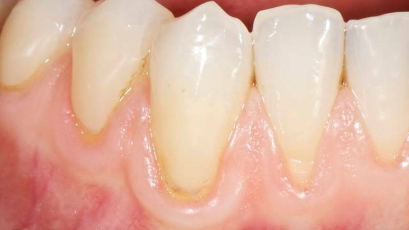 tandköttsrecession behandling utan kirurgi