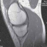 Ruptuur van de achterste hoorn van de mediale meniscus