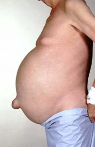 Buik met ascites