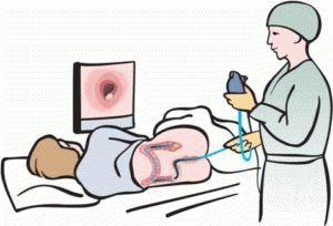 Como se livrar das pedras fecais do intestino com remédios populares?