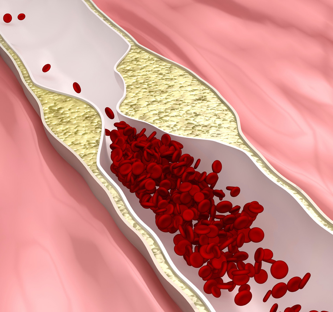 Koronarna arterijska bolest (CHD): što je to, simptomi, liječenje