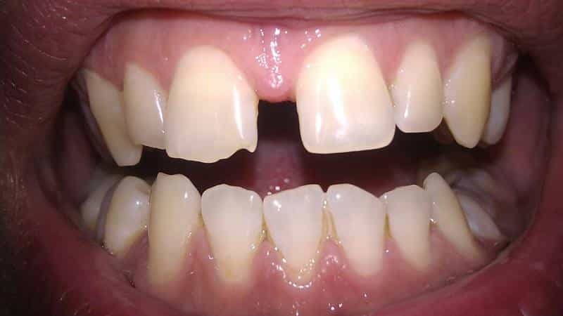 cómo solucionar el hueco entre los dientes delanteros