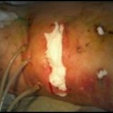 Purulent surgery: pancreatic necrosis
