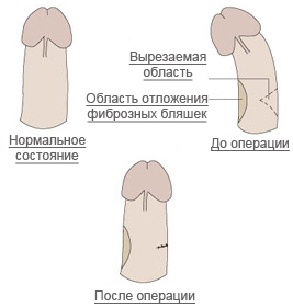 Klasična operacija za ispravljanje zakrivljenosti penisa