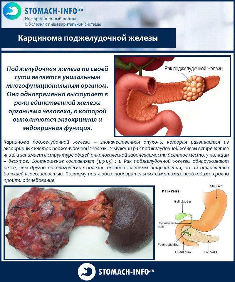 Carcinoma pancreático