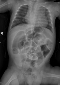 Intestinal obstruction in a child