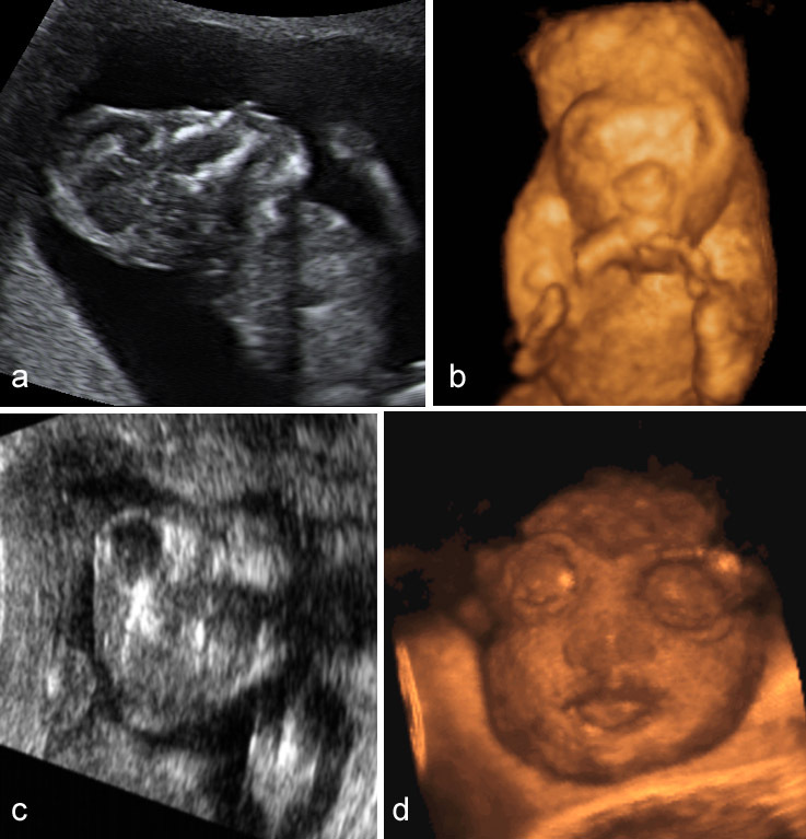 Anencefalia fetal: o que é, sinais no ultrassom, prognóstico