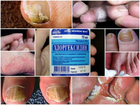 Por que salen hongos en las uñas de los pies