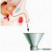 Uroflowmetry for the diagnosis of diseases of the urinary bladder