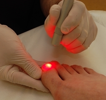 Treatment of nail fungus with laser