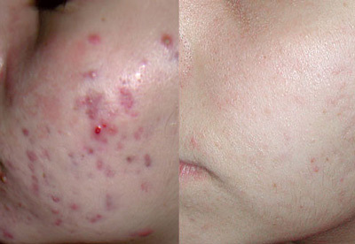 Laser fjernelse af acne og acne