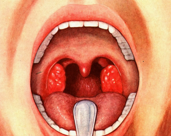 Herpetic tonsillitis: symptoms and treatment
