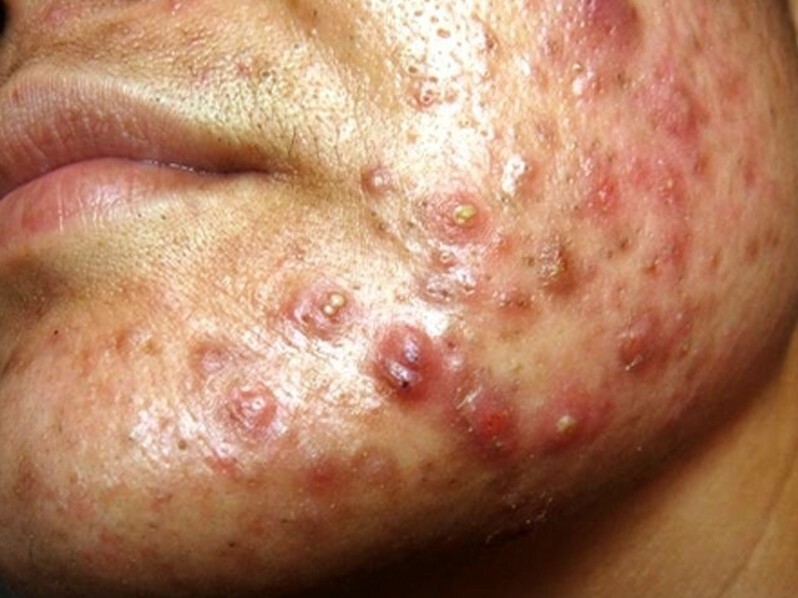 acne conglobata-foto
