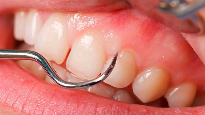 Die Ursachen für Zahnfleischerkrankungen