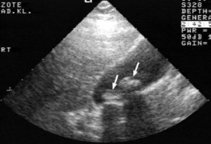 Echografie van galorganen