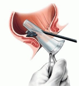 Escleroterapia de hemorroides