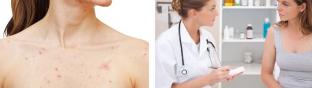 Ursachen von Akne am Körper und Brustbein bei Männern