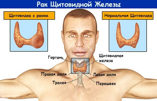 Symptoms of Thyroid Cancer