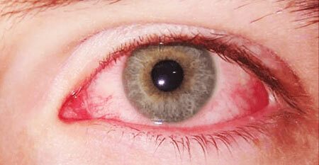 Herpes Auge