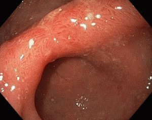 Allochol avec pancréatite: peut-il être pris, cela aidera-t-il?