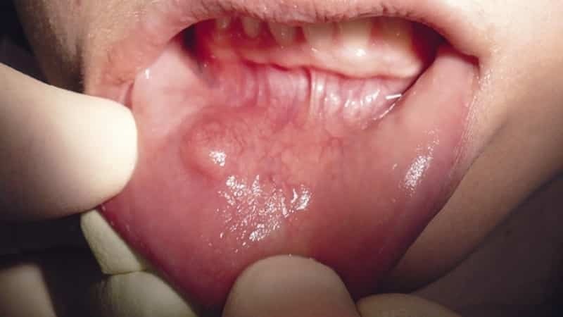 En cyste i munnen: bilde, behandling, hvordan å diagnostisere