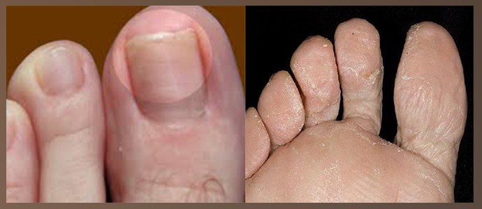 Celandine contra fungo das unhas dos pés: análises, receitas, instruções de uso