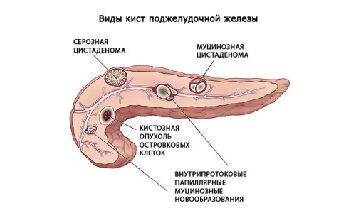 Arten von Pankreaszyste