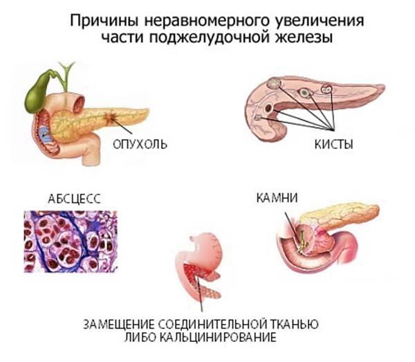 Causas do aumento desigual de uma parte do pâncreas