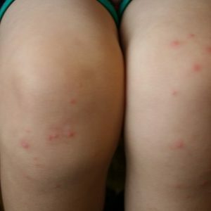 Alergije na rukama i nogama bebe: uzroci i liječenje