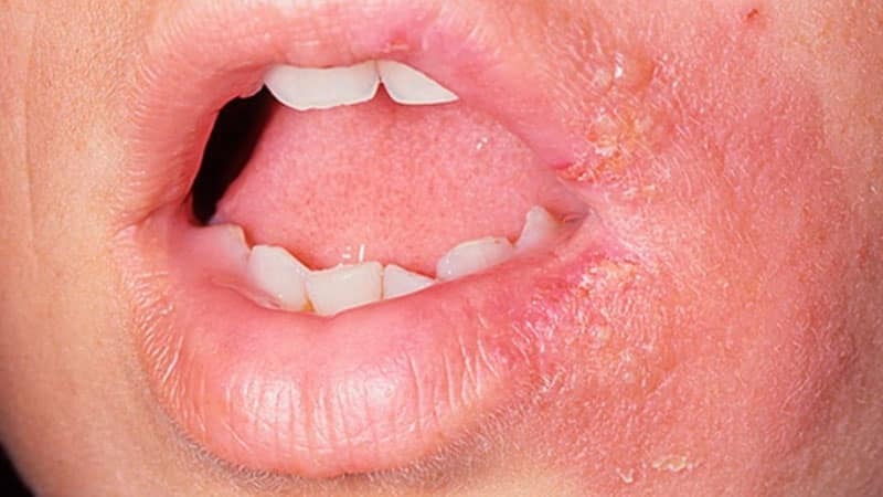 Ogorčena na usne, ali nije herpes: lijek