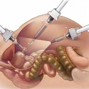 Laparoscopy-in-gynecology