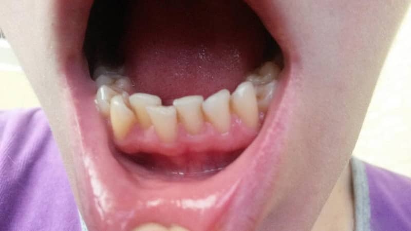 Är det möjligt att rikta tänder utan tandställning
