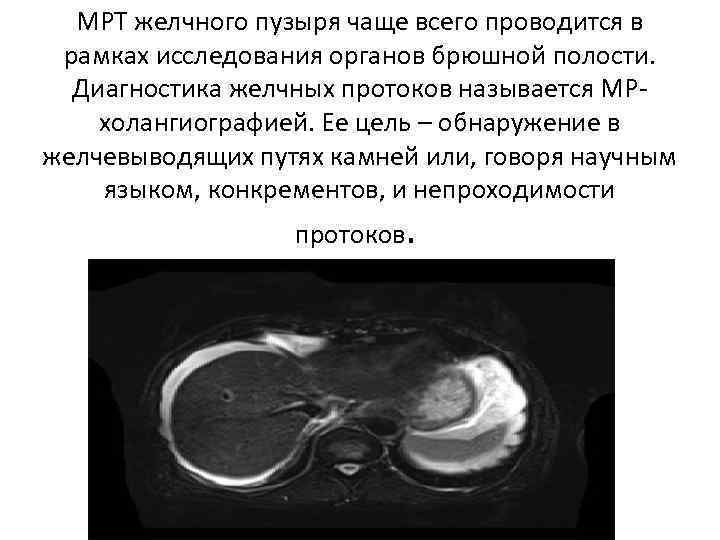 MRI of the gallbladder