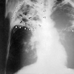 Cirrhotic pulmonale tuberculose