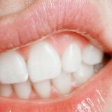 Folk Heilmittel für die Behandlung von Zahnfleisch