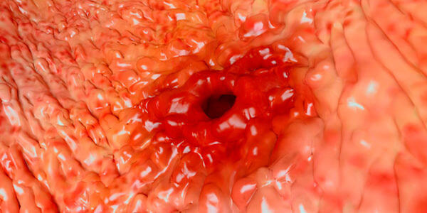 Hemorrhagiás gastritis