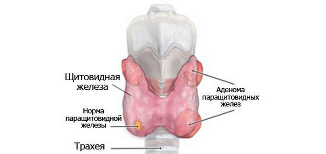 Adenoma-parathyroid glands