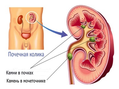 Treatment of kidney stones
