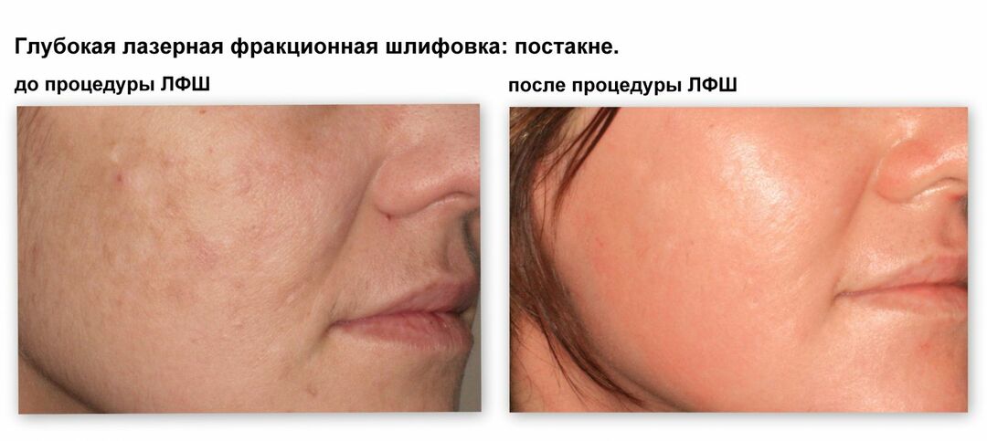 Hoe zich te ontdoen van sporen van acne: beproefde methoden