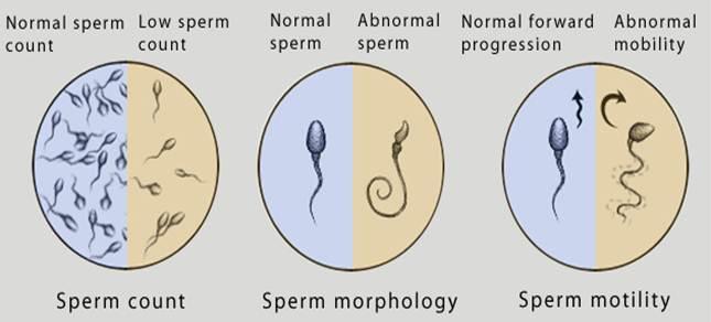 Teratozoospermic causes of and ways to treat