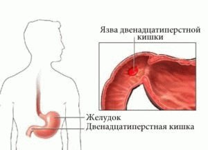 ulcus duodeni